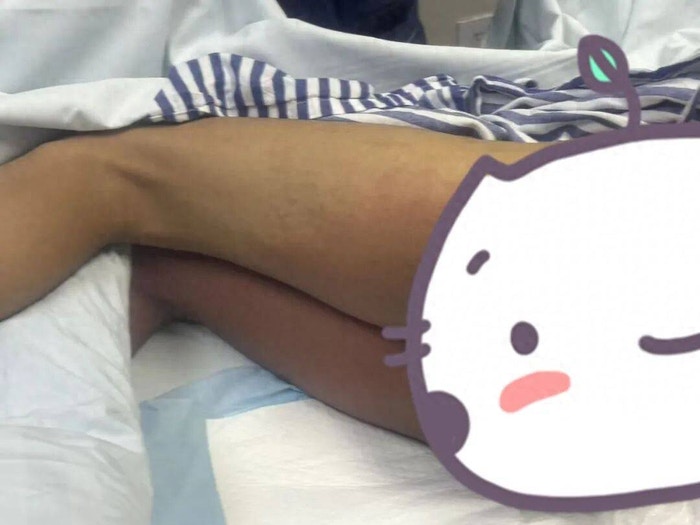 患者腿部皮肤出现严重灼伤与水泡