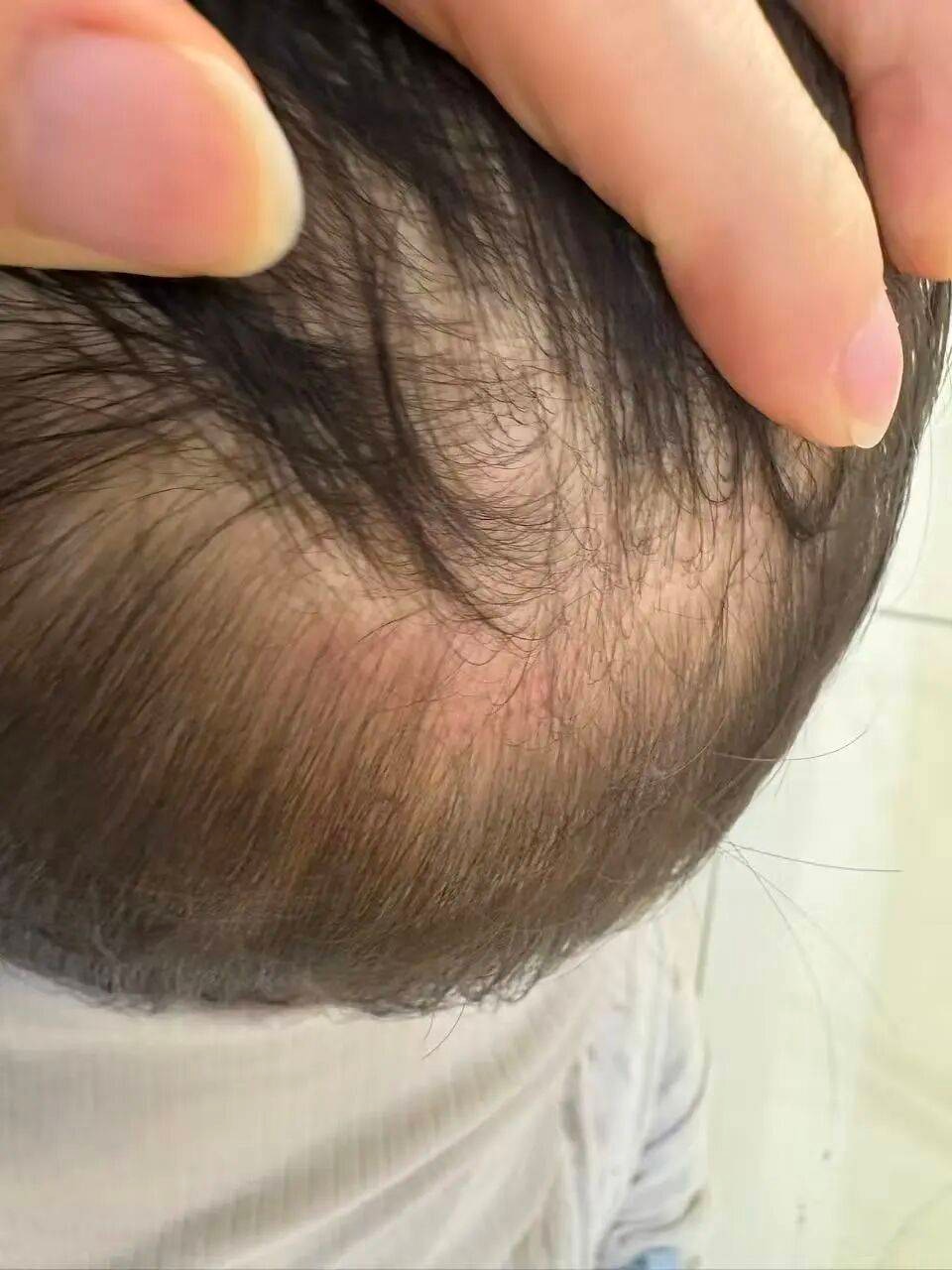 幼儿后脑勺伤痕照片